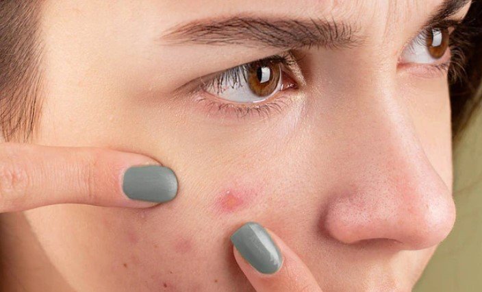 Pimple Patch Makes acne Disappear